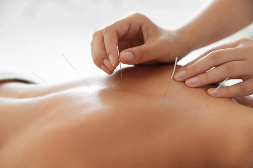 Accupuncture